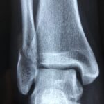 radiography, diagnosis, anatomy, injury, radiology, bone, healthcare, xray, health, medical, disease, ankle, sprain, fracture, blue health, blue medical, blue healthcare, xray, xray, xray, xray, xray, ankle, fracture