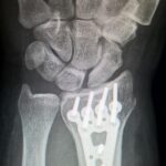 broken arm, plate fixation, titanium plate, fracture of radius, wrist, surgery, trauma surgery, x-ray image, bone, broken arm, broken arm, broken arm, broken arm, broken arm, surgery, surgery, bone